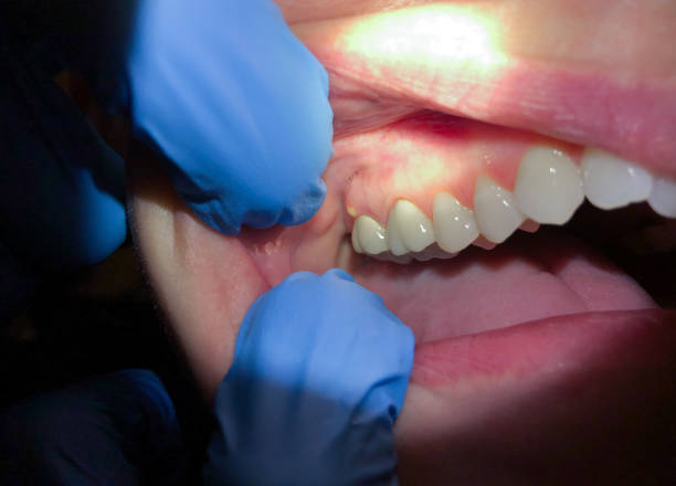 Best Lost Filling or Crown Replacement in Munising, MI